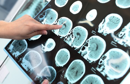 7 habitudes pour prévenir la maladie d'Alzheimer