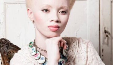Albinisme : l'exemple émouvant de Thando Hopa