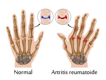 Les 7 étapes pour surmonter une arthrite rhumatoïde