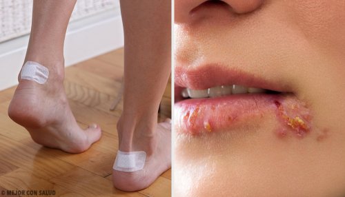 5 conseils pour éradiquer les ampoules