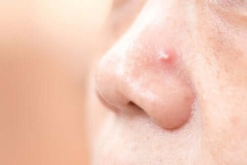 Boutons sur le nez : 4 remèdes naturels maison - Améliore ta Santé