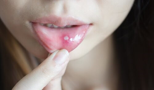 Comment soigner les aphtes et les plaies buccales ?