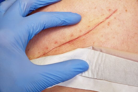 Techniques de base pour bien soigner une plaie