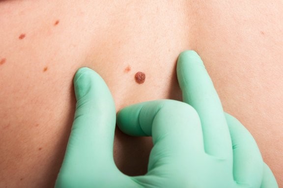 Qu'est-ce que le test ABCDE en dermatologie ?