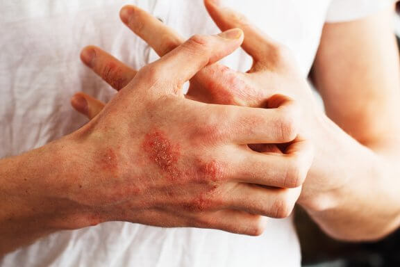 Les aliments permettant de contrôler le psoriasis
