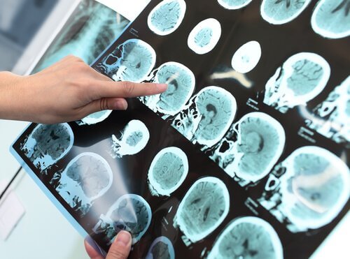 Les symptômes du trouble neurocognitif majeur