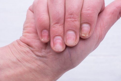Solutions maison pour se débarrasser de l'aspect "ongles jaunes"