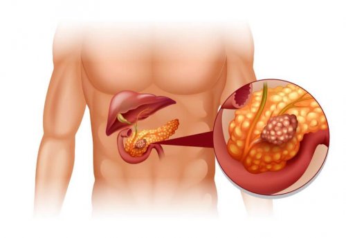 Traitement des tumeurs neuroendocrines du pancréas