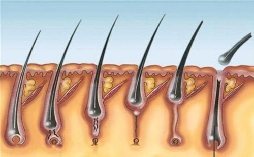 Pilomatricome multiple : caractéristiques et causes