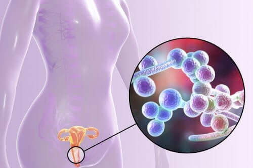 Tout savoir sur la candidose vulvo-vaginale