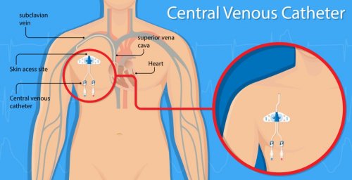 Perforation vasculaire par cathéter veineux central
