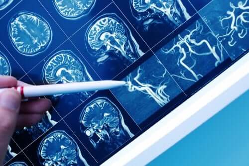 La démence vasculaire, en quoi cela consiste ?