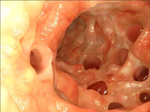 Le diverticule de Meckel : définition et caractéristiques