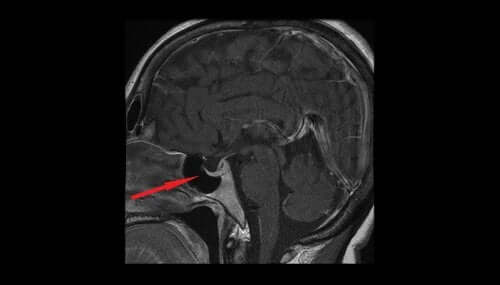 Qu'est-ce que l'adénome hypophysaire ?
