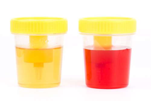 Hématurie : ses symptômes et ses causes