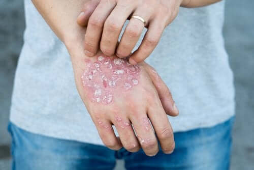 Maladies dermatologiques dues au stress