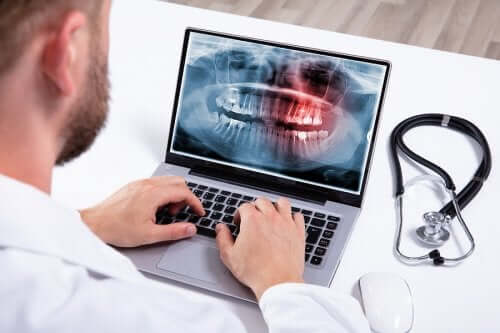 Hyperdontie : causes et traitement