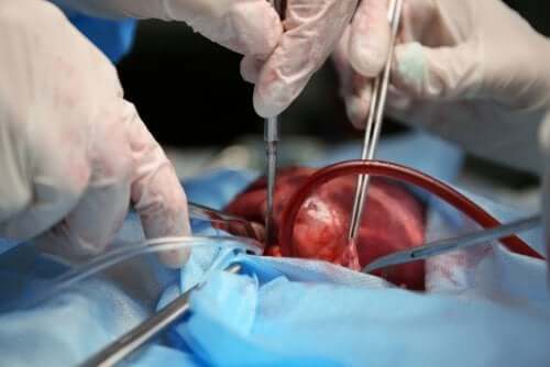 Un cœur artificiel qui promet d'aider ceux qui n'ont pas de donneur