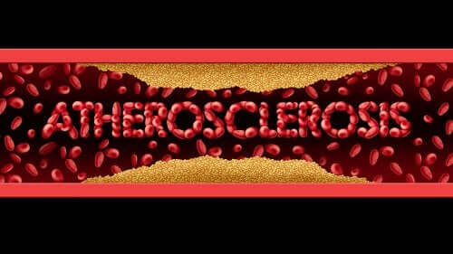 L'athérosclérose : symptômes et traitement
