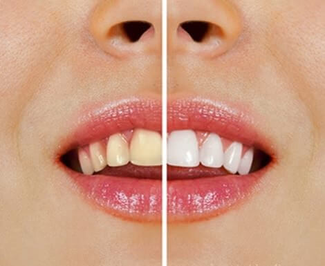 Produits naturels pour blanchir les dents