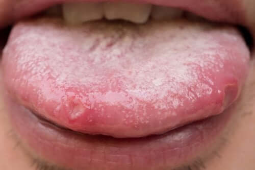 Remèdes pour la candidose orale : des alternatives naturelles