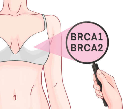 Rôle des gènes BRCA-1 et BRCA-2 dans le cancer du sein