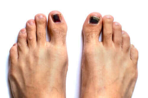 Ongles noirs : comment les traiter ?