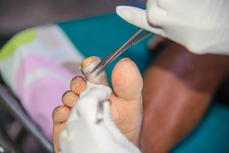 La gangrène : causes et symptômes