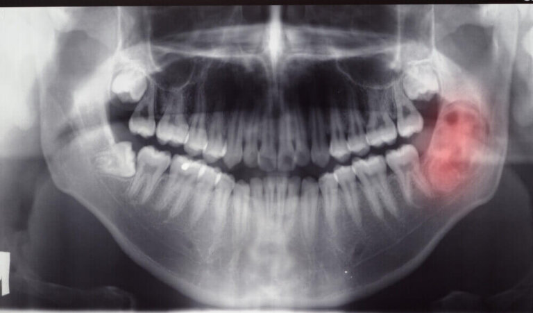 Diagnostic des tumeurs et kystes de la mâchoire