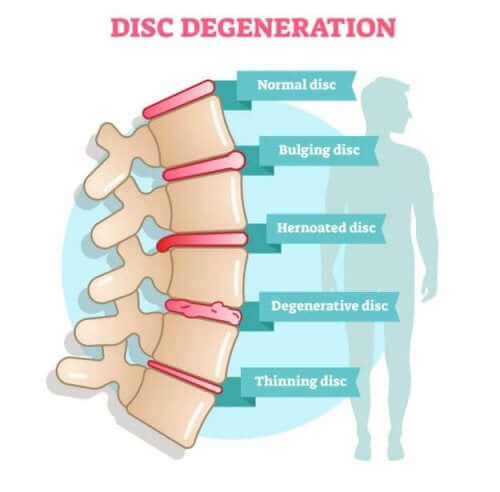 Symptômes de la discopathie dégénérative