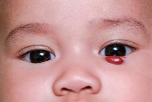Un hémangiome infantile, qu'est-ce que c'est ?