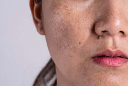 L'hyperpigmentation : pourquoi se produit-elle ?