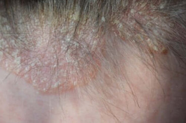 Psoriasis du cuir chevelu : symptômes et traitement