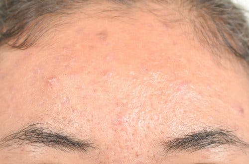 Remèdes naturels pour traiter la dermatite séborrhéique