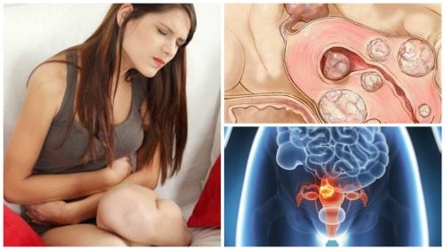 5 données à connaître sur les fibromes utérins