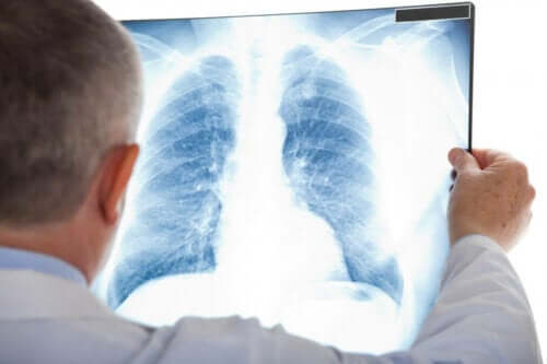 Qu’est-ce que la pneumonie atypique ?