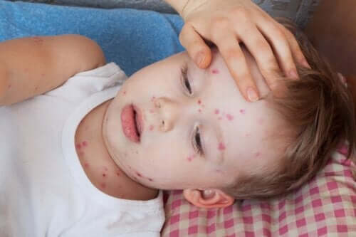 Comment traiter l'urticaire chez les enfants ?