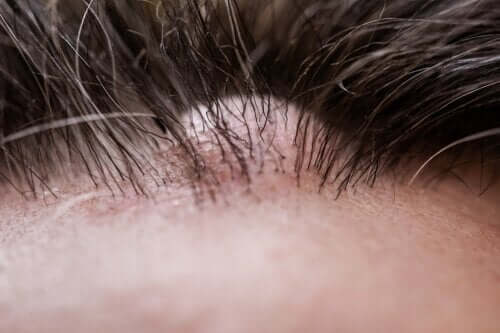 Qu'est-ce qu'un dermatofibrome ?
