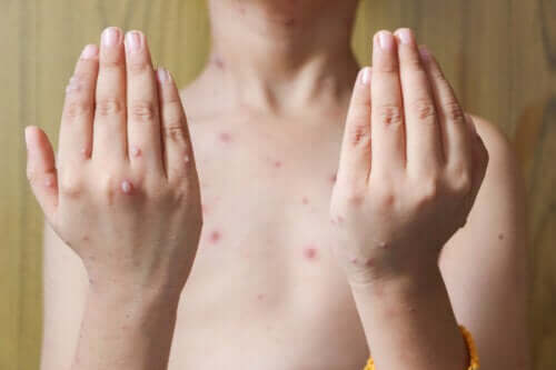 Herpès zoster chez les enfants : causes, symptômes et traitements