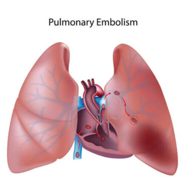 Tout ce que vous devez savoir sur l'embolie pulmonaire