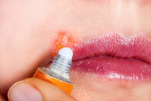 Herpès labial : symptômes et traitement