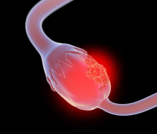 Qu'est-ce qu'un cystadénome mucineux géant de l'ovaire ?