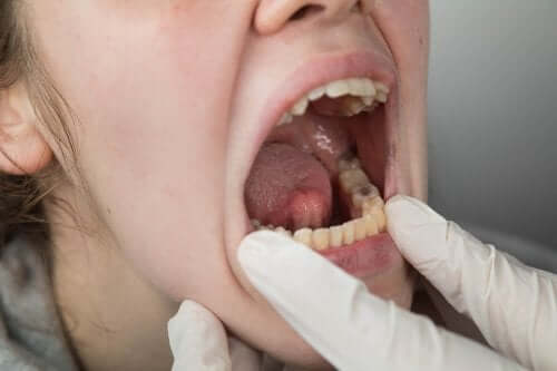 Facteurs de risque du cancer oral