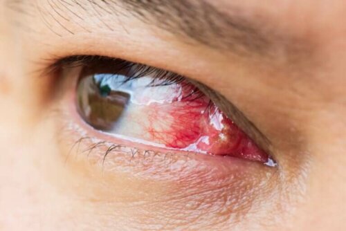 Excroissance sur les yeux : qu'est-ce que c'est et pourquoi apparaît-elle ?