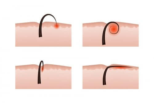 Poils incarnés : causes et soins