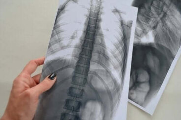 Radiographie lombaire : dois-je m'inquiéter ?