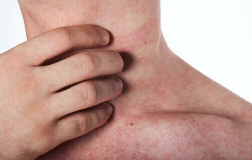 A quoi servent les antihistaminiques ?