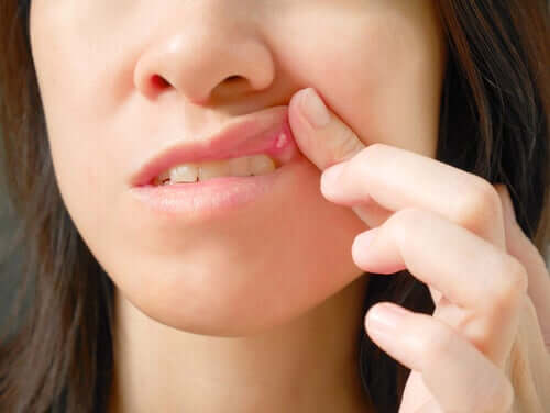 Les aphtes : causes et traitements