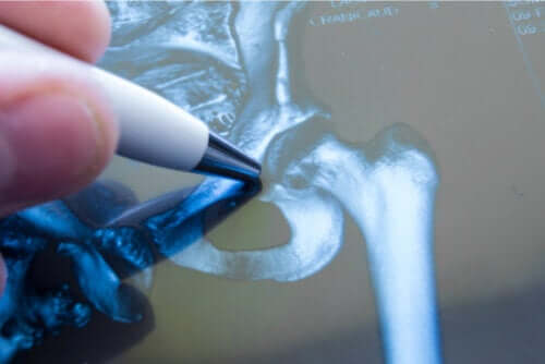 Fracture de la hanche : tout ce qu'il faut savoir