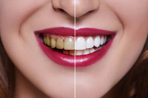 Causes des dents tachées
